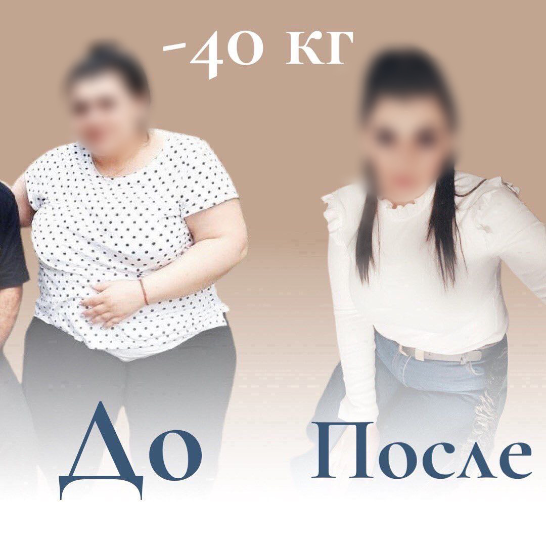 Результат бариатрической операции: минус 40 кг