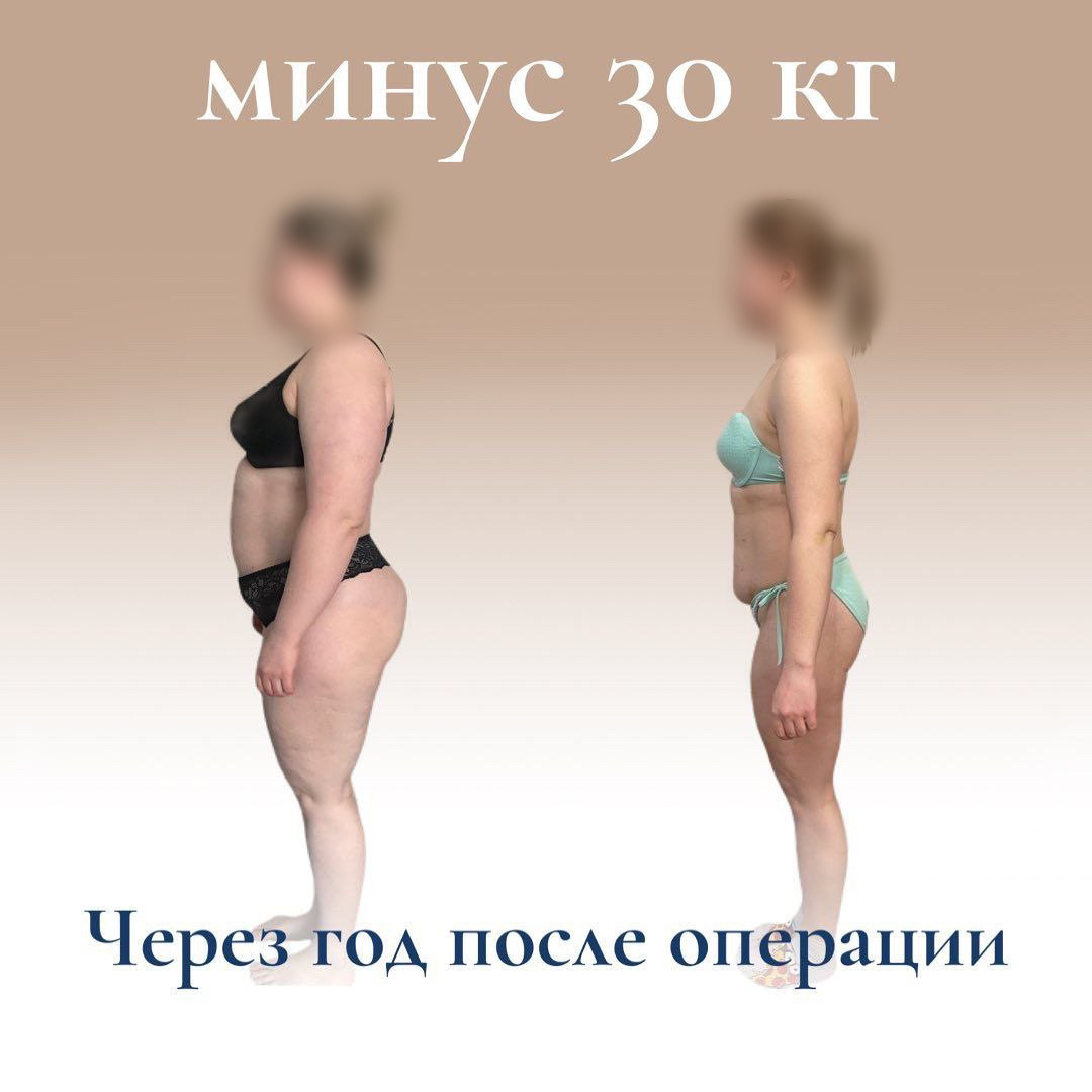 Результат бариатрической операции: минус 30 кг