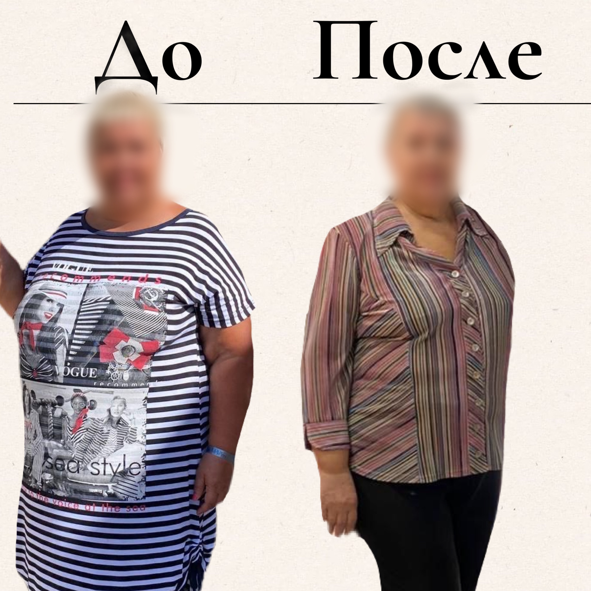Результат бариатрической операции через год после операции